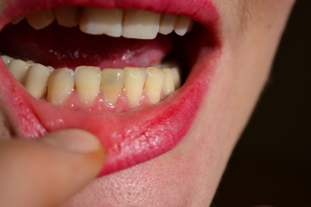 до установки - голливудские виниры Харьков