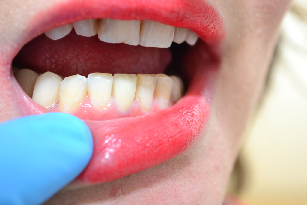 голливудские виниры Харьков до лечения