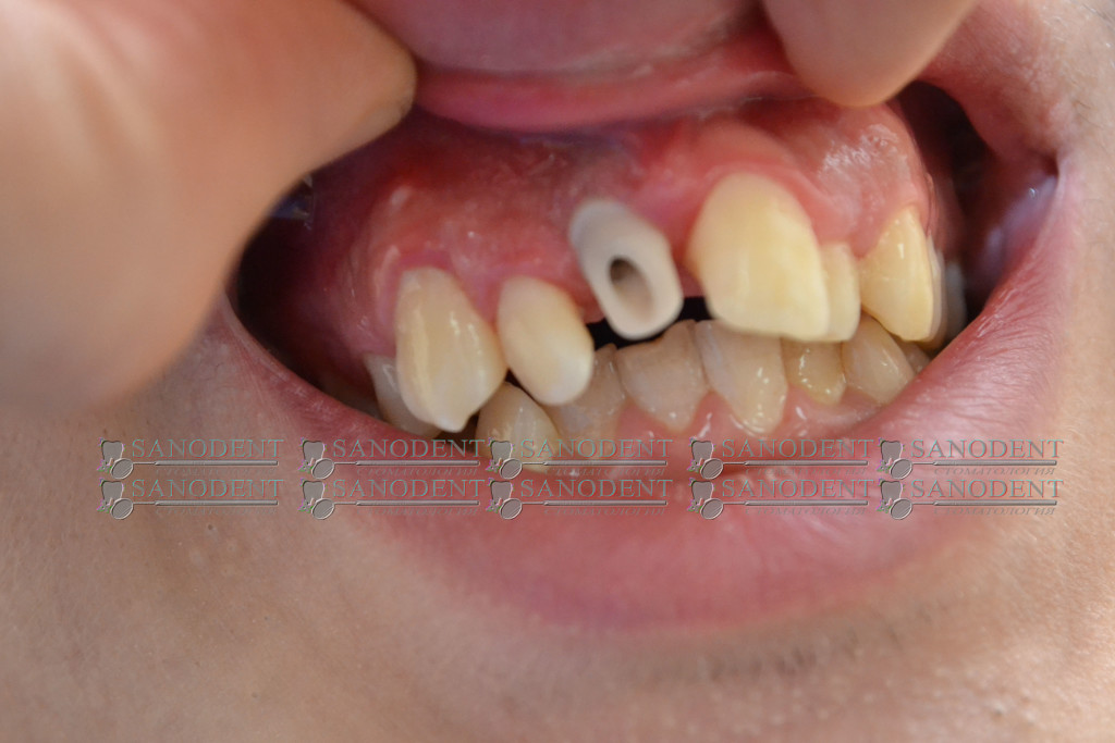 имплантация переднего зуба, циркониевый абатмент