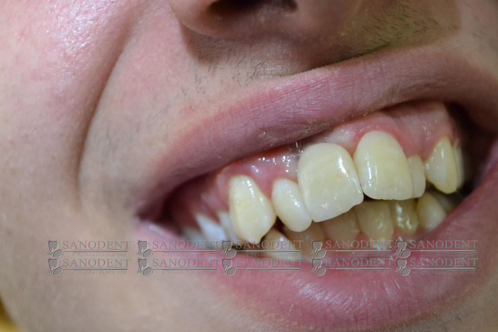 воссоздание цвета и формы зуба керамической коронкой