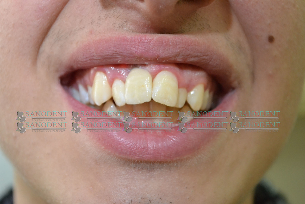 воссоздание цвета и формы зуба керамической коронкой