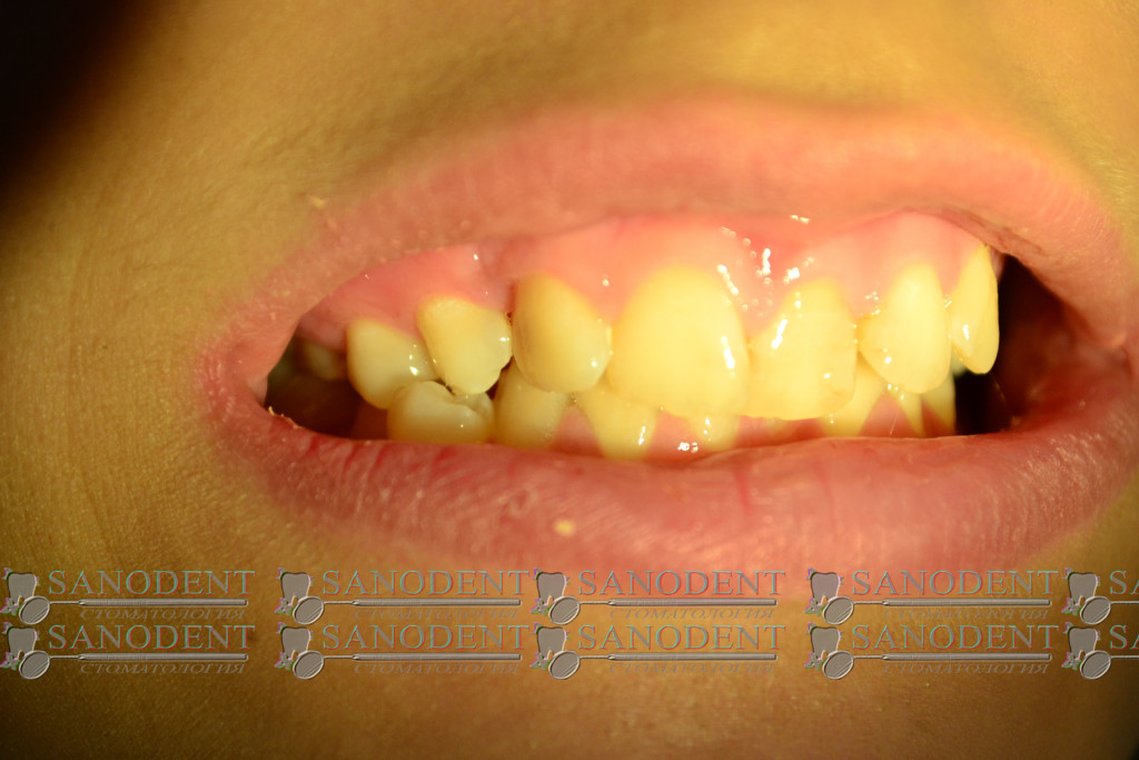 искривление зубного ряда с дефектами эмали