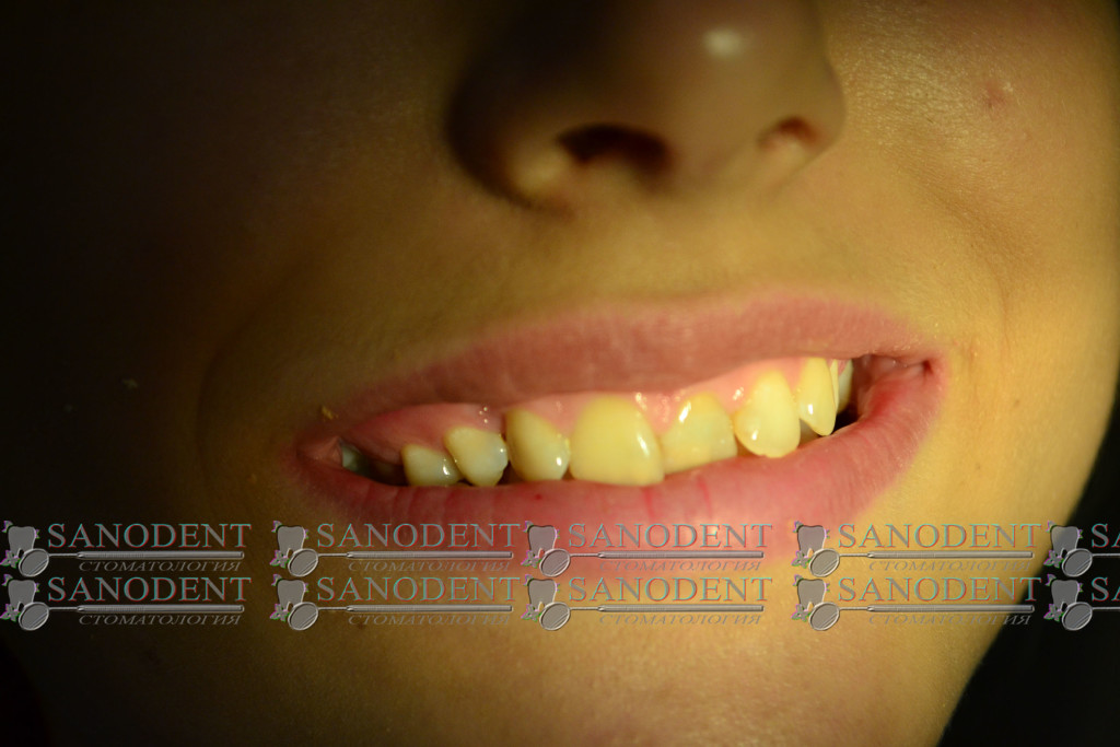 искривление зубного ряда с дефектами эмали