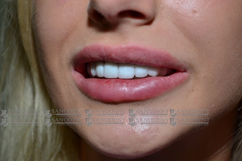 протезирование керамическими винирами в Харькове