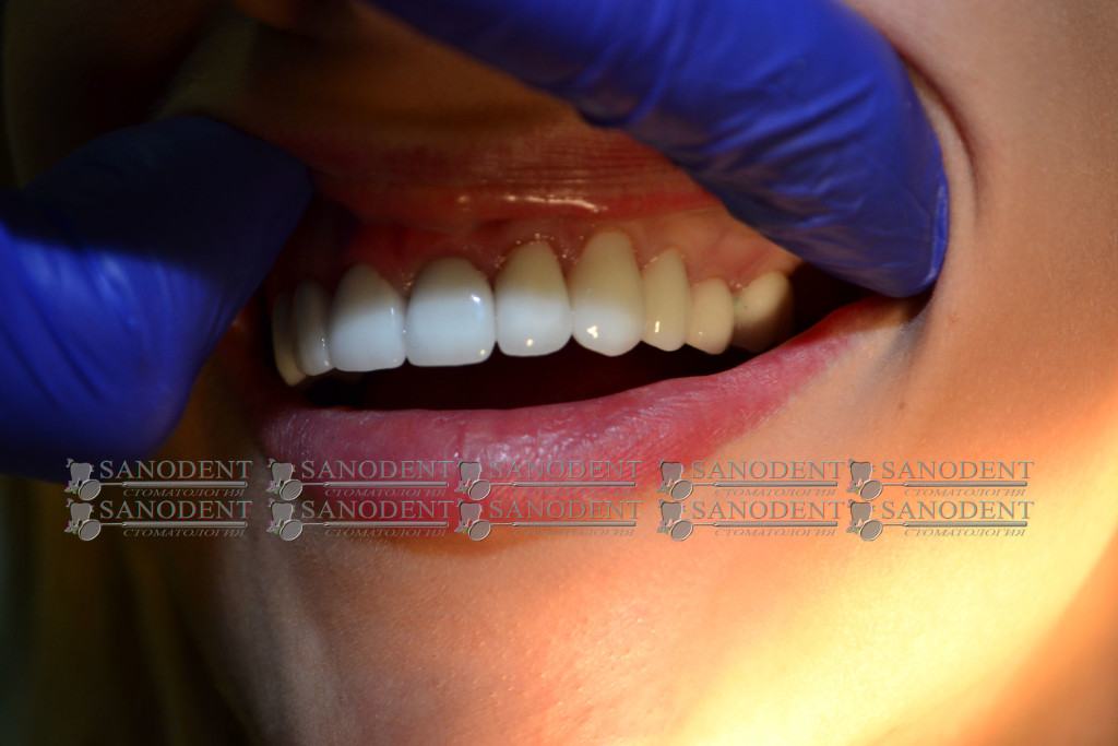 протезирование керамическими винирами в Харькове