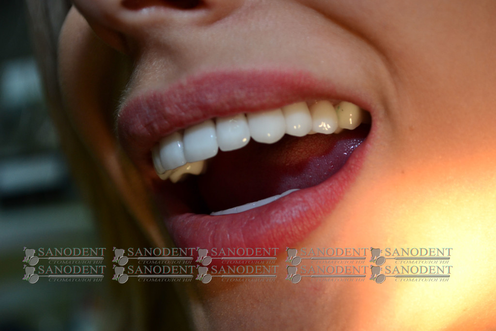 протезирование керамическими винирами в Харькове