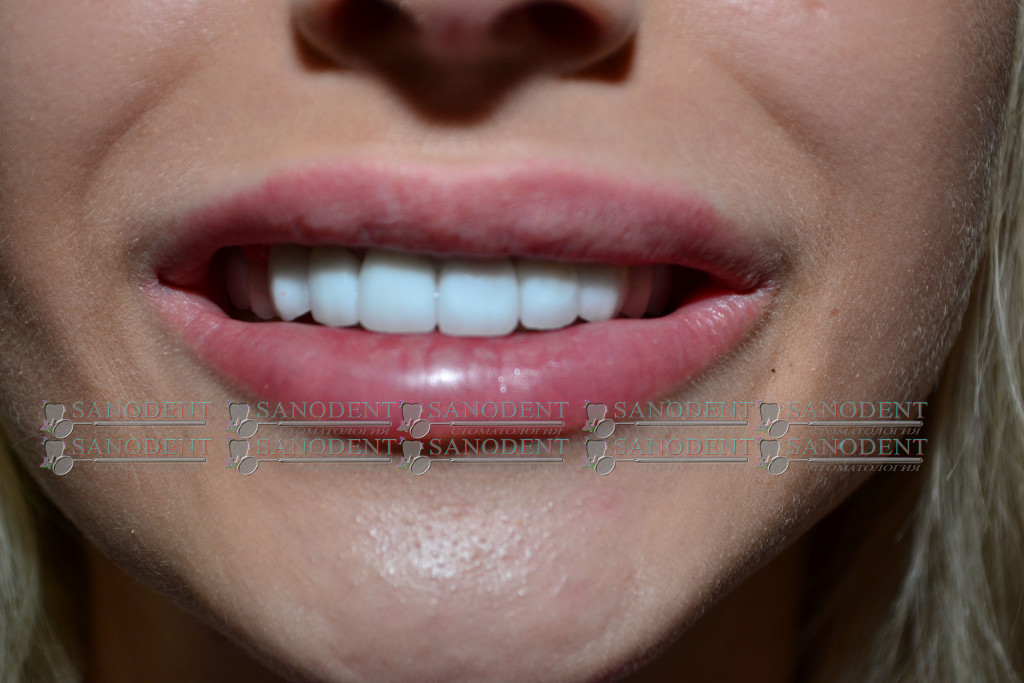 протезирование керамическими винирами в Харькове