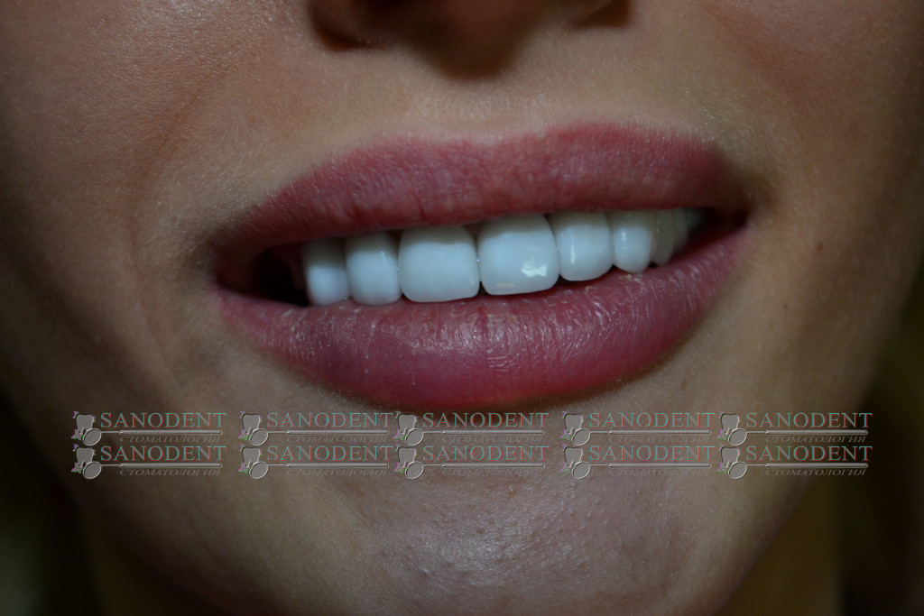 протезирование керамическими винирами в Харькове