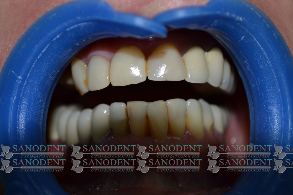 фото до лечения и протезирования