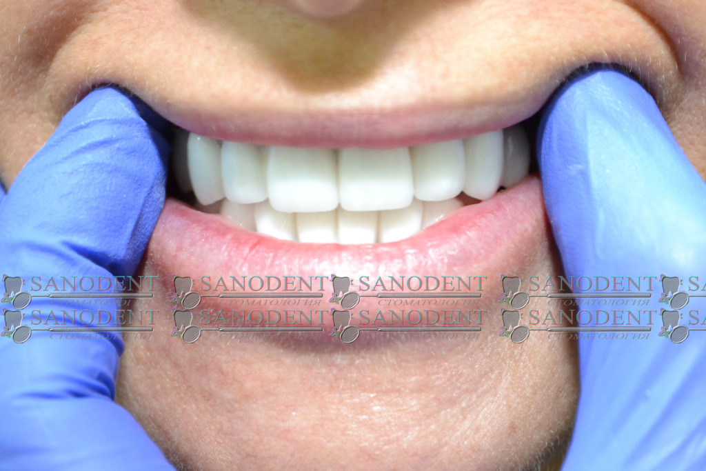 после лечения и протезирования зубов