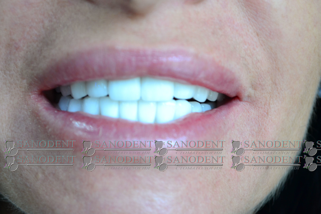 яркая улыбка после лечения