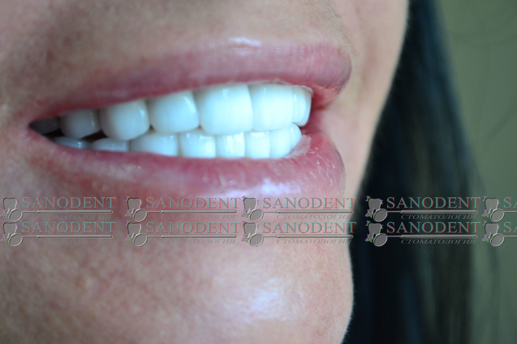 протезирование зубов в Харькове