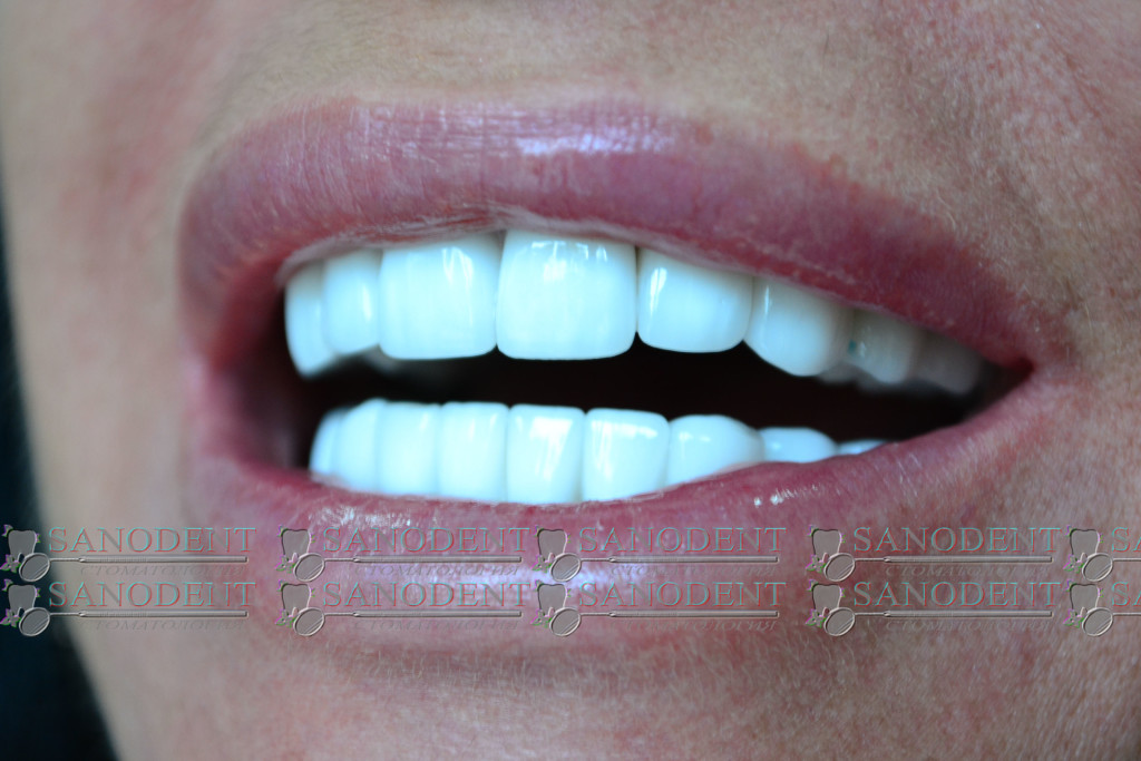 безметалловая керамика харьков