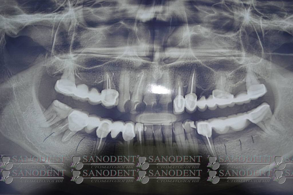 панорамный снимок челюстей