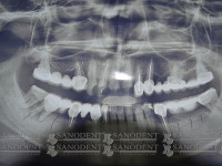 панорамный снимок челюстей