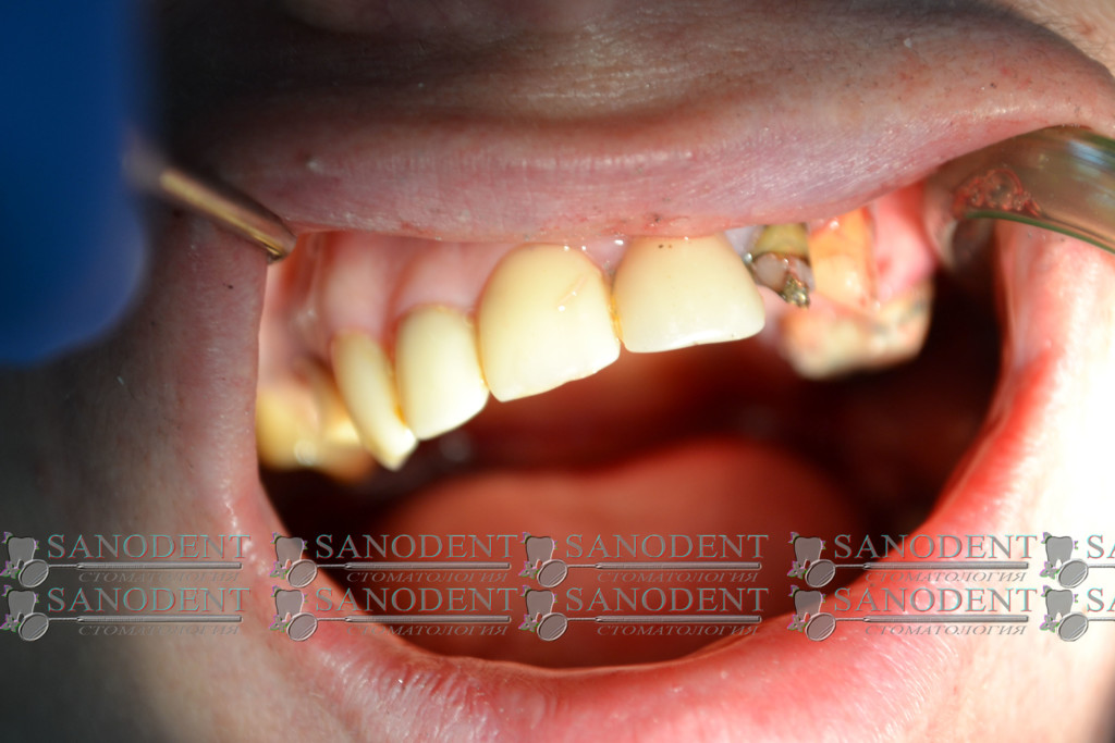 в процессе снятия мостовидных протезов