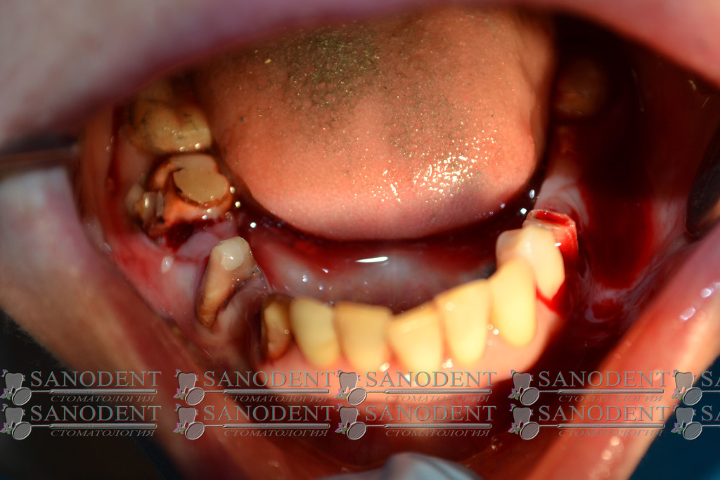 снятие мостовидных протезов