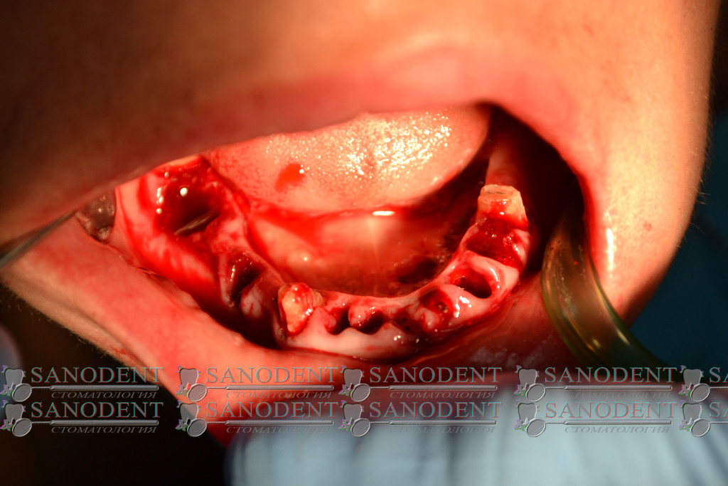 удаление зубов в Харькове