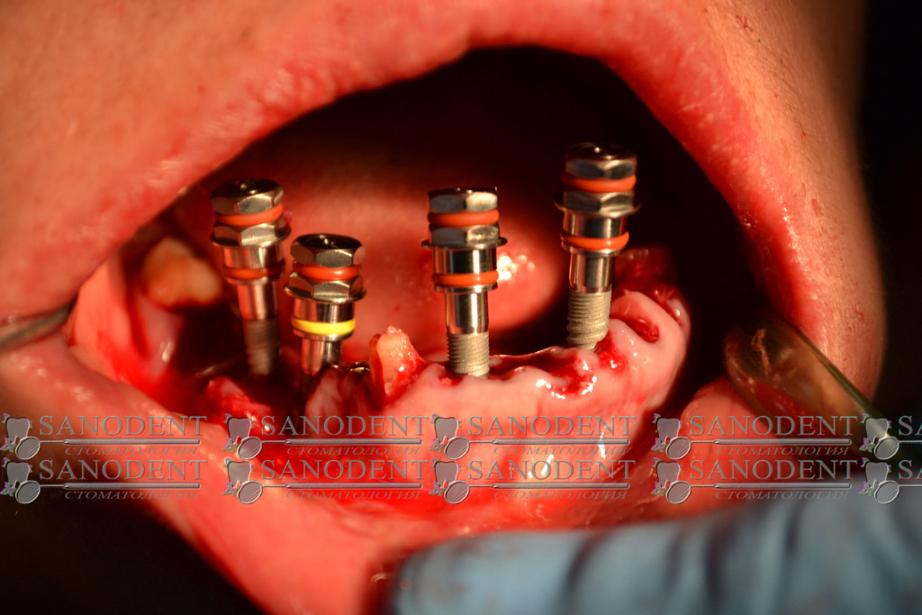 имплантация зубов фото