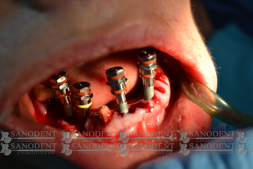 имплантация зубов в Харькове