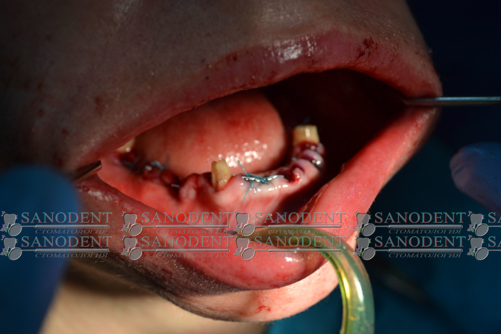 наложение швов после имплантации