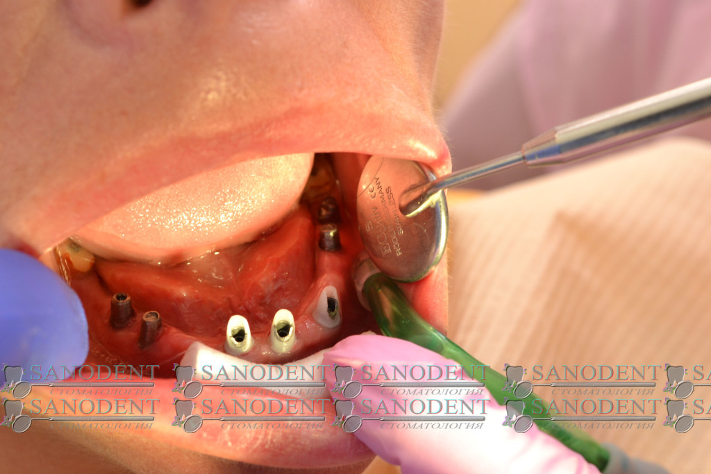 установка абатментов на импланты