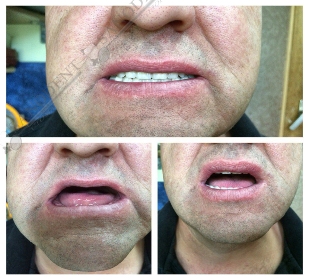 съемное протезирование зубов, пациент Санодент