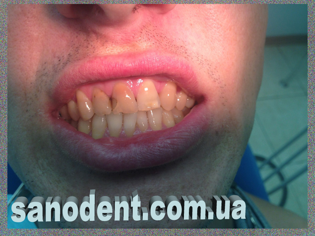 до реставрации зубов