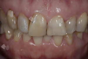 проблемы с зубами, необходимо реставрировать