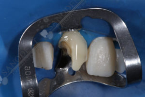 изоляция рабочего поля коффердамом, реставрация зуба