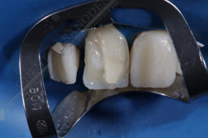 эстетическая реставрация зубов в Харькове