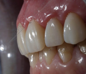 эстетическая реставрация зубов в Харькове