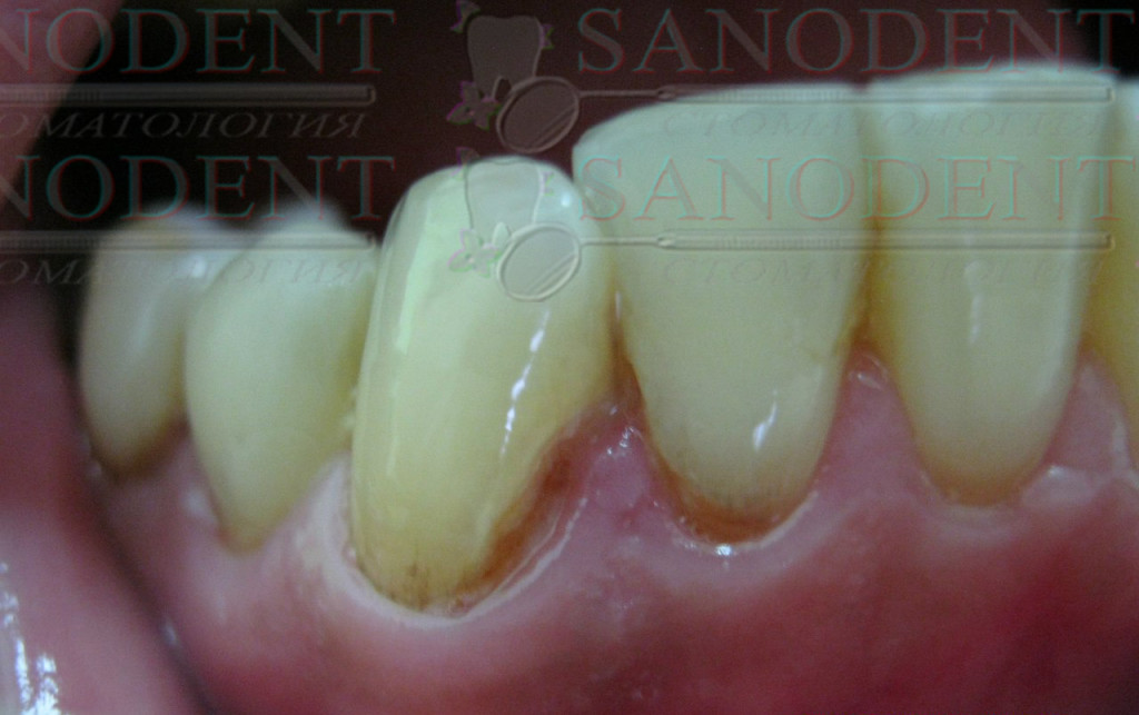 реставрация зубов