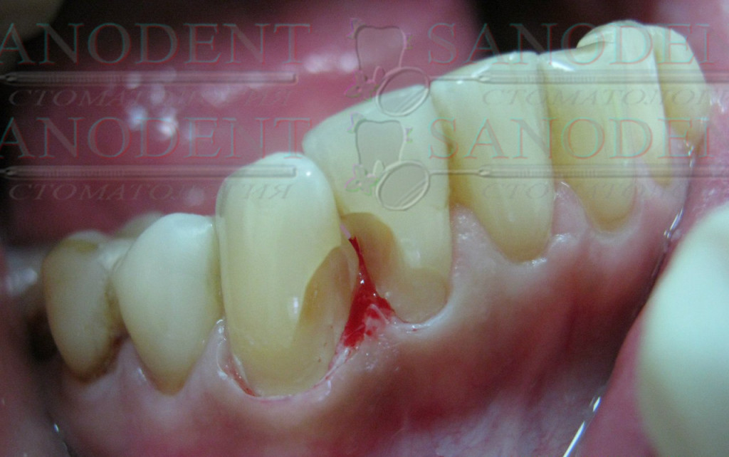 удаление кариозных зон