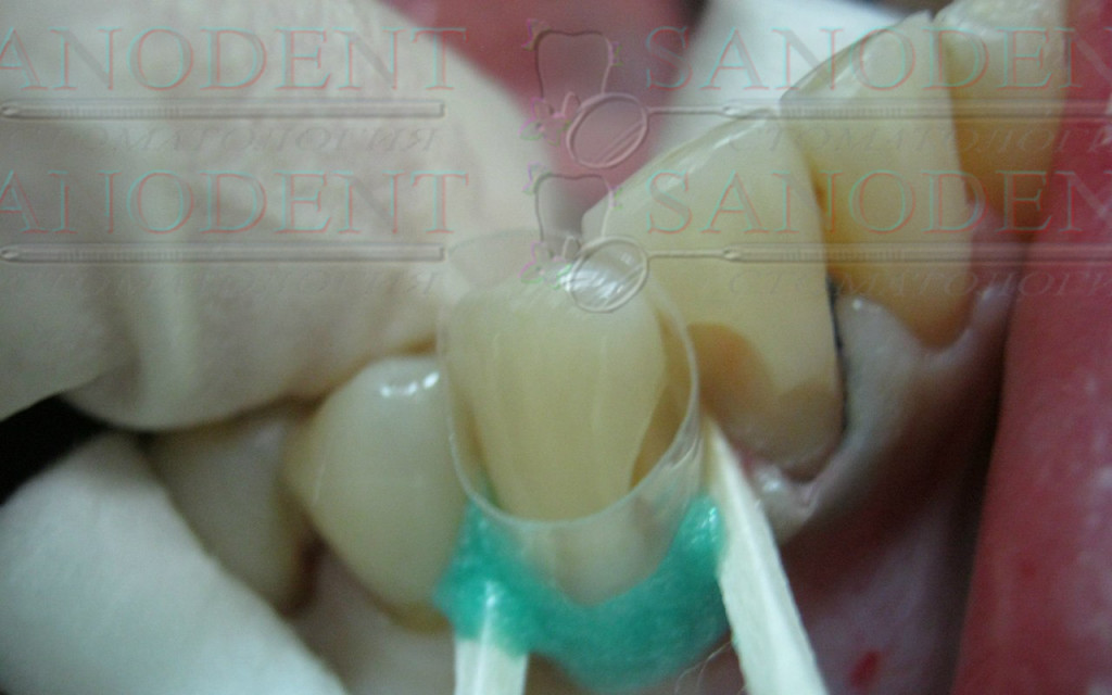 изоляция пространства перед лечением кариеса