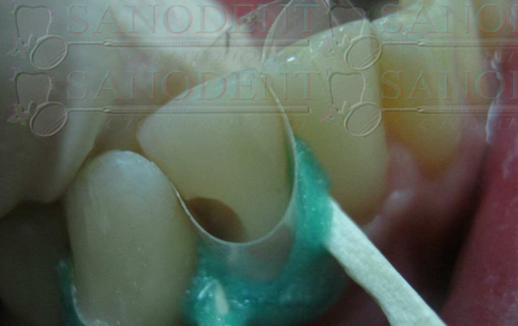 подготовка полости зуба под реставрацию