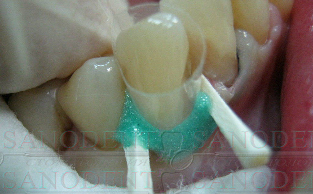 подготовка полости зуба под реставрацию