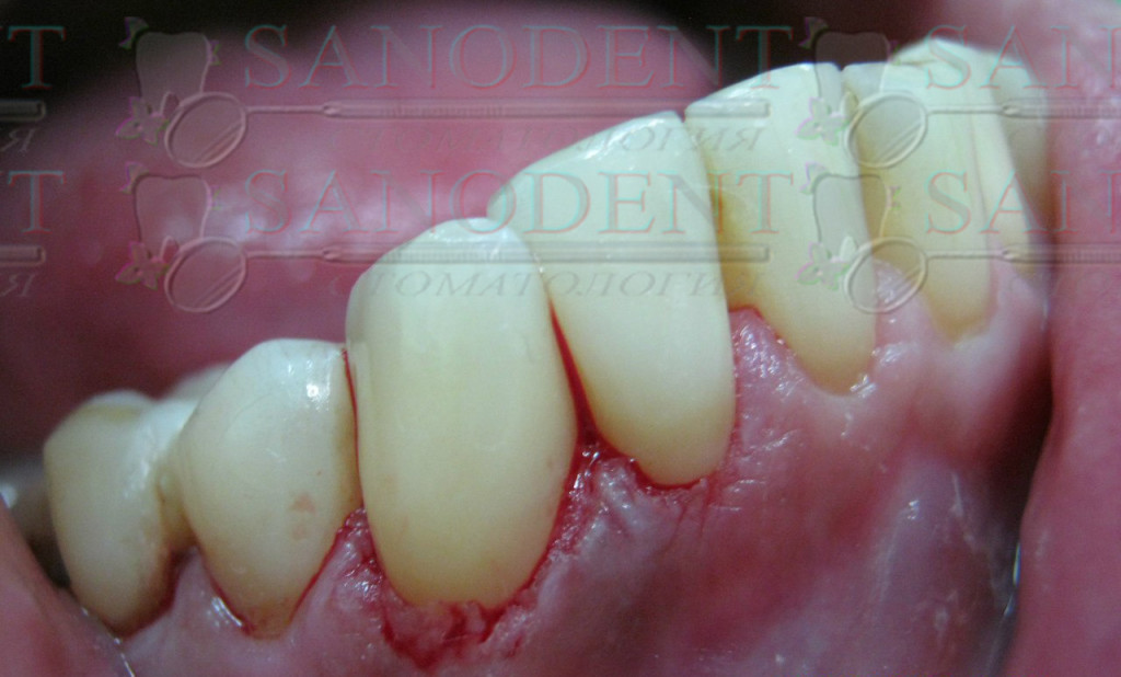 вид после лечения кариеса