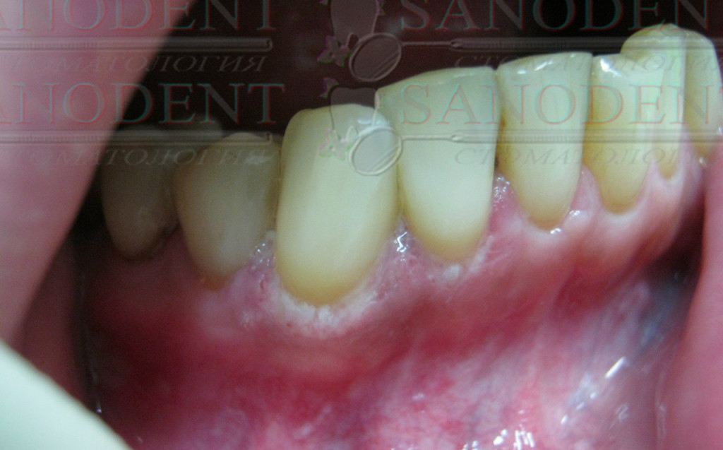 фото после лечения кариеса