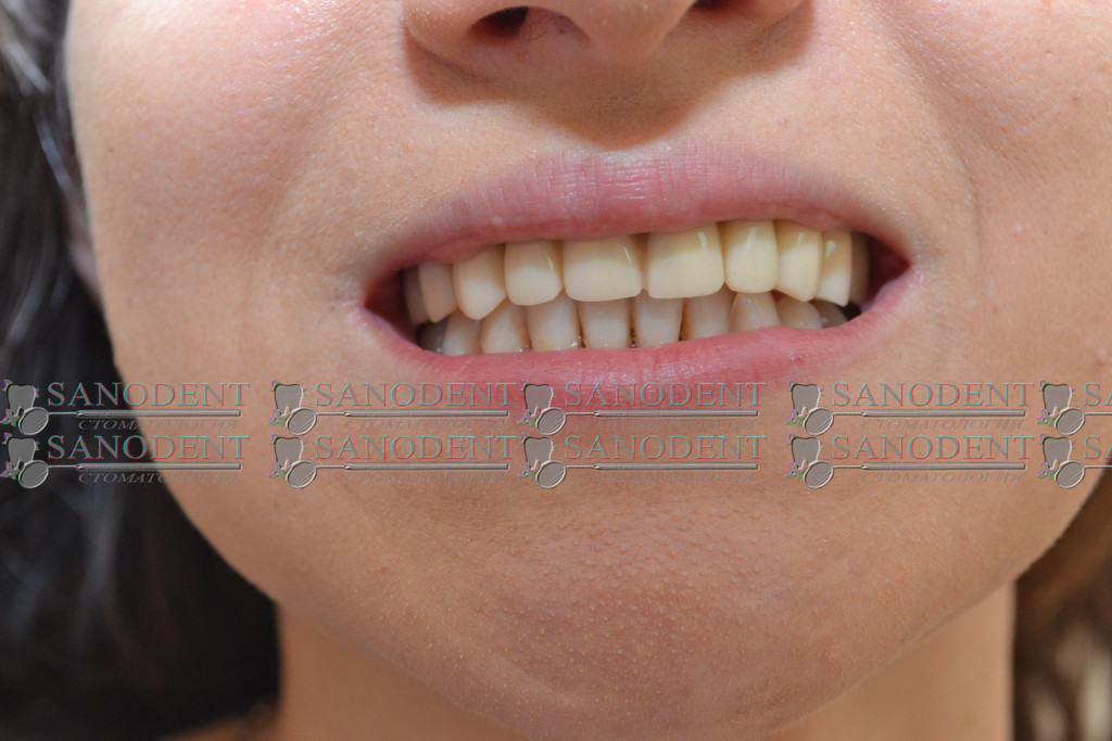 фото до лечения в Санодент