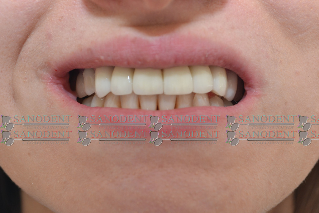 фото вид после протезирования