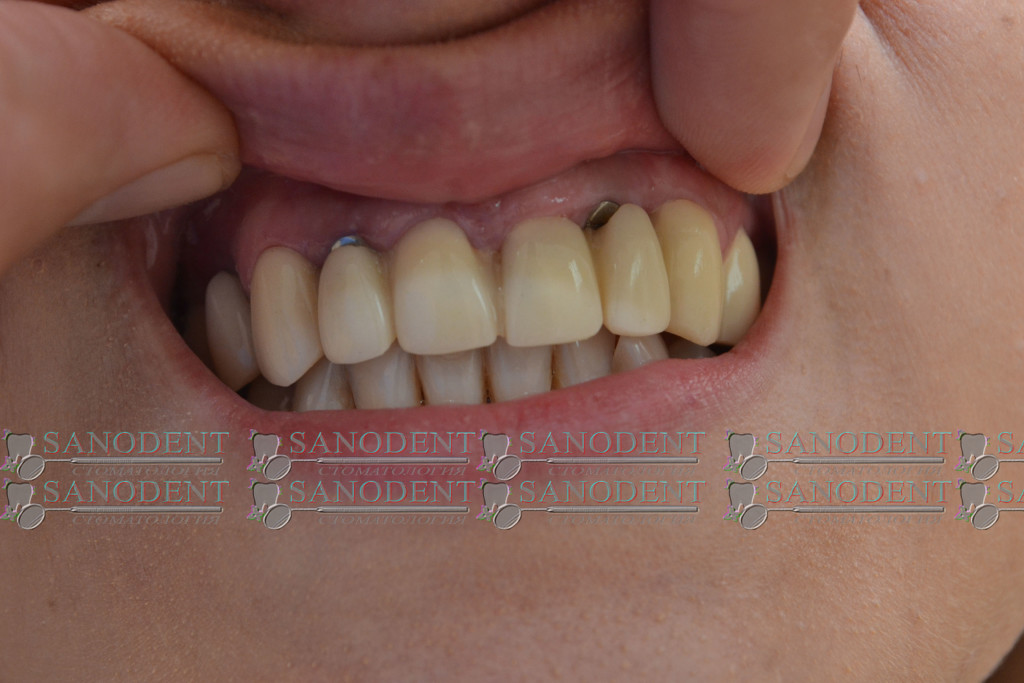 Старые металлокерамические мосты