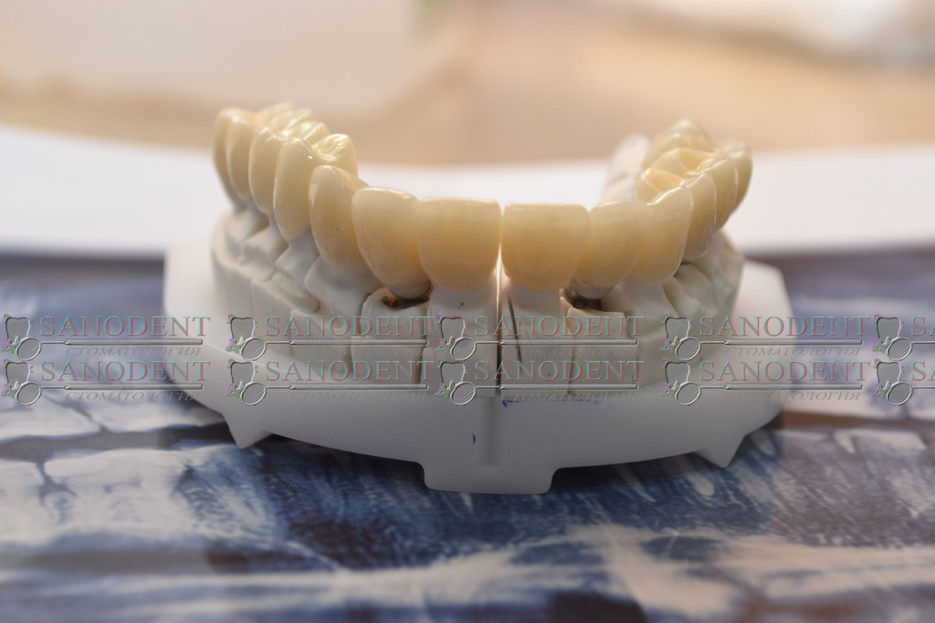безметалловые коронки на модели