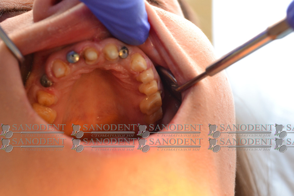 установка имплантов и препарация