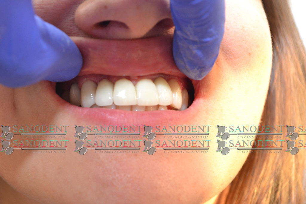 отличное прилегание коронок к десне