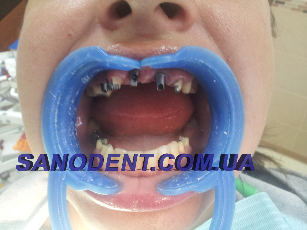 протезирование зубов на имплантах Харьков, имплантация зубов Харьков