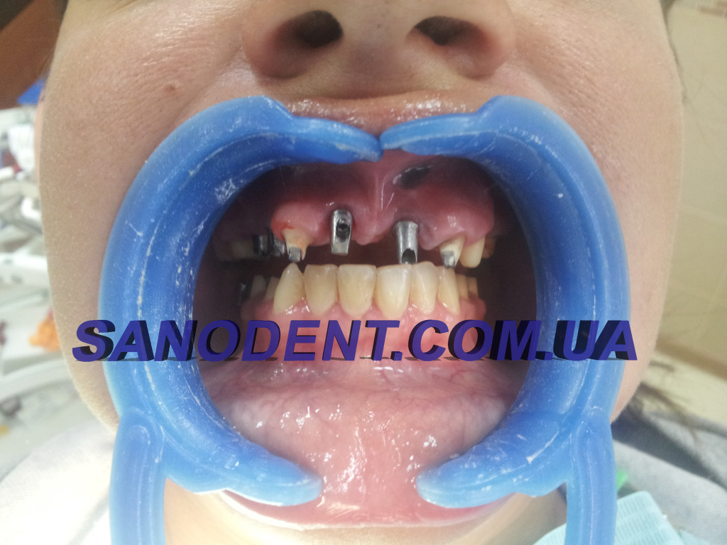 процесс исмлантации зубов