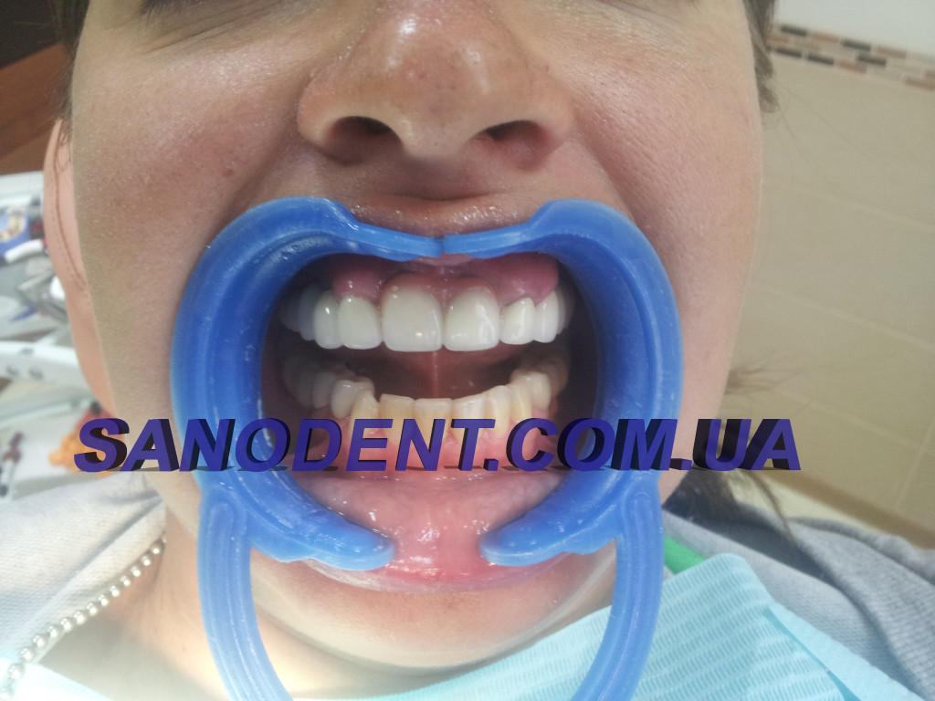 новые коронки, успешное лечение