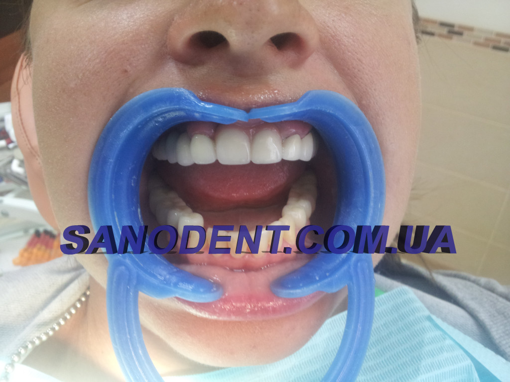 после протезирования зубов