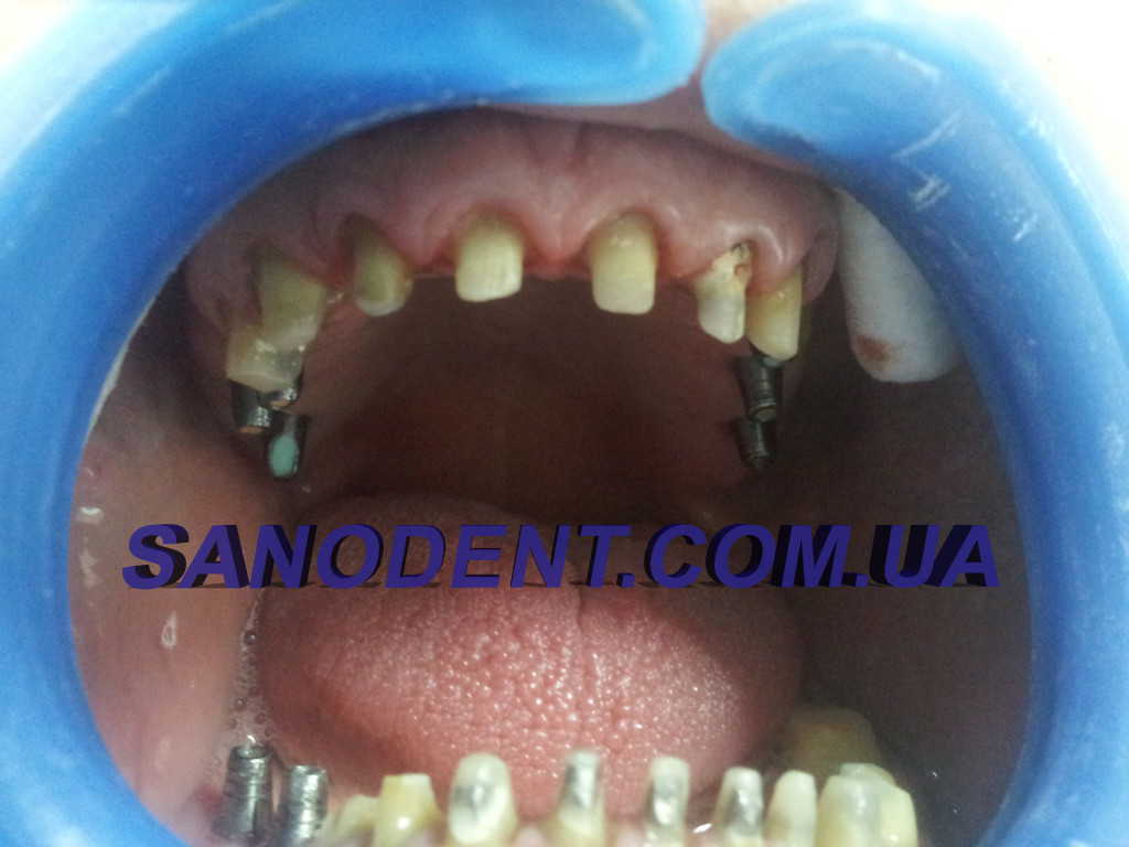 Протезирование зубов Харьков | протезирование зубов безметалловая керамика E-max